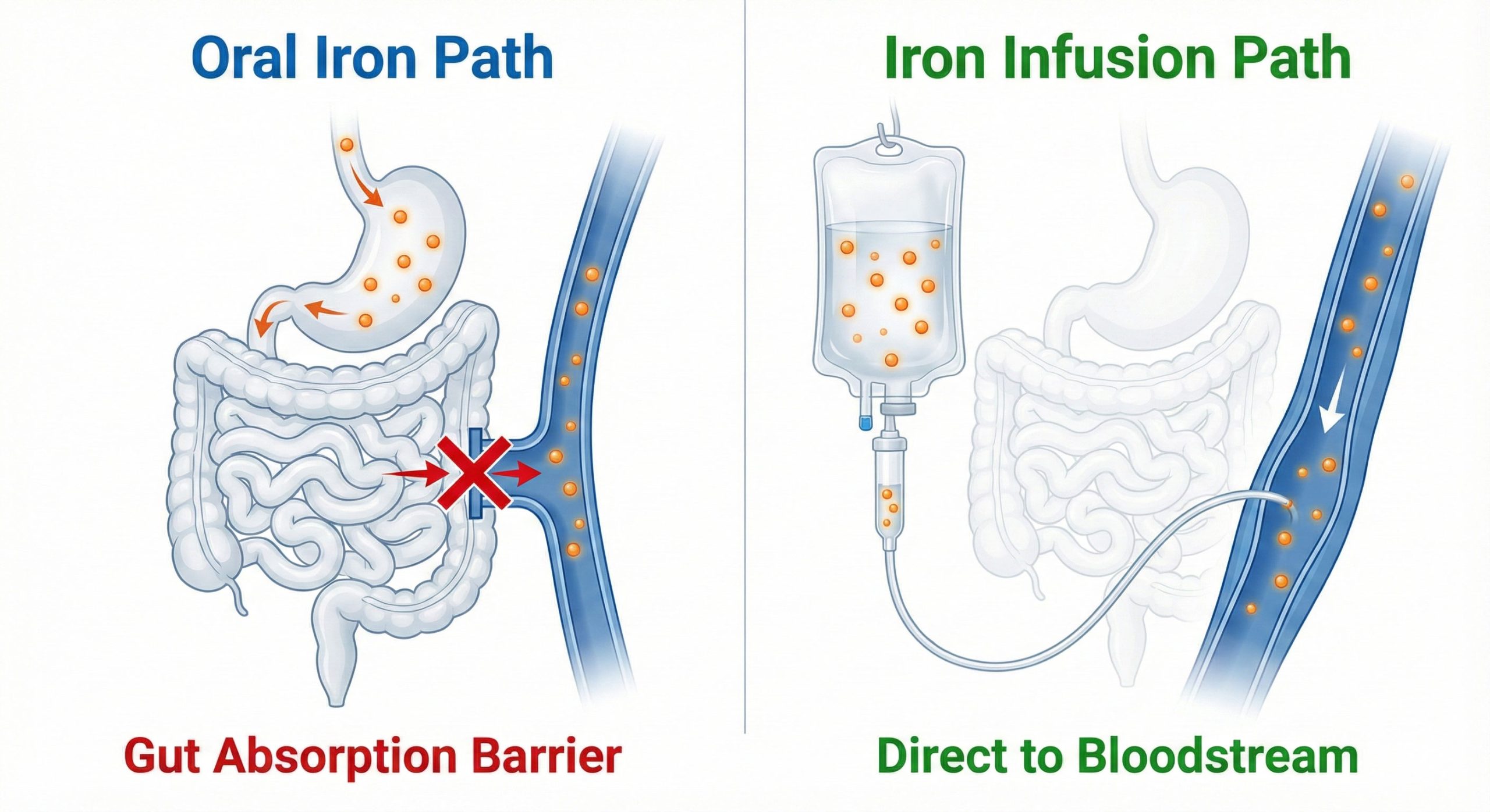 Iron Infusions and Gut Health Why Oral Supplements Don’t Always Work